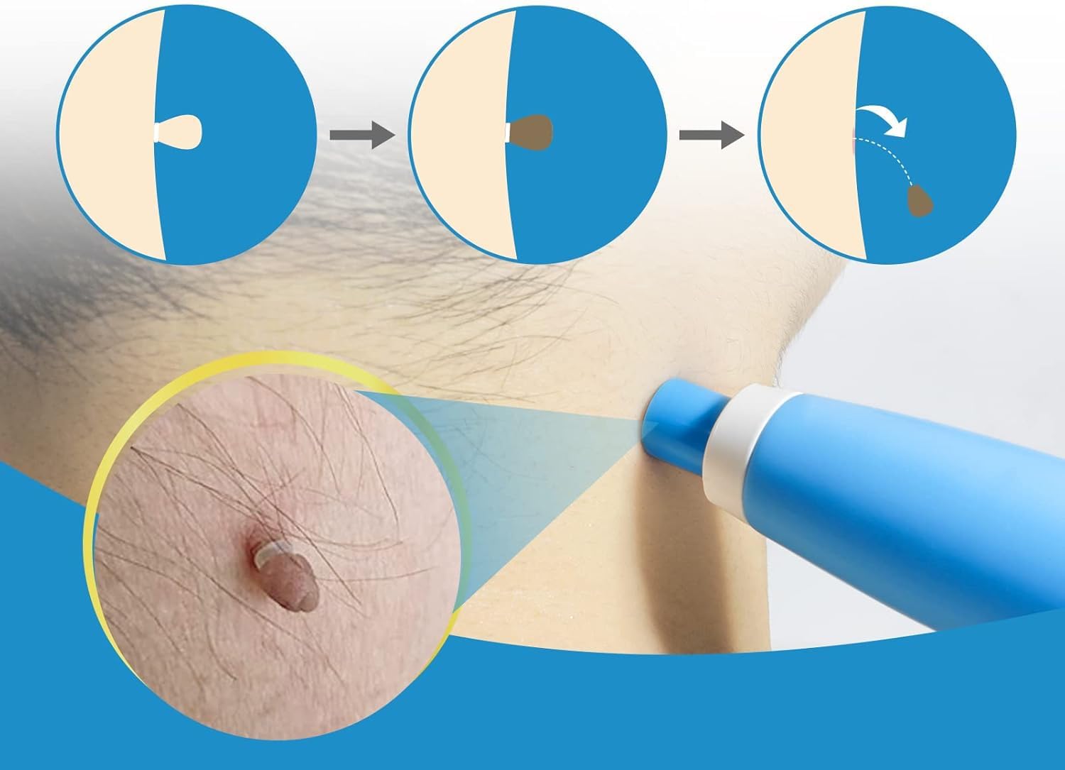 Painless Auto Skin Tag & Mole  - Health Wellness ulasan dan harga