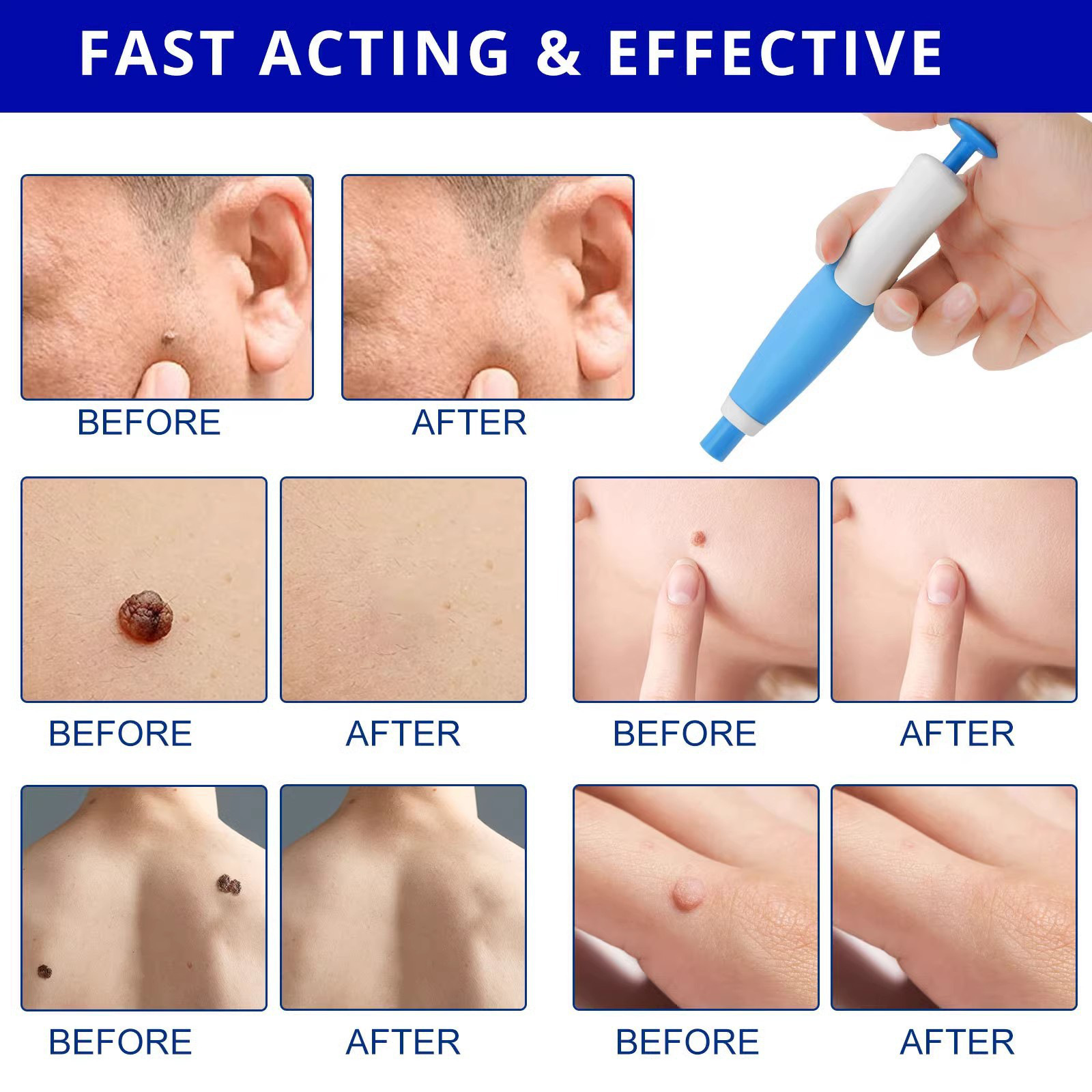 Painless Auto Skin Tag & Mole  - Health Wellness ulasan dan harga