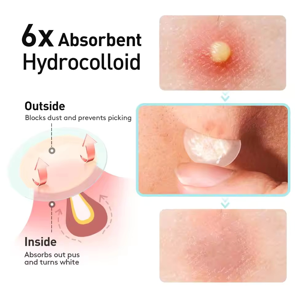 360 pieces/box acne patches -  - Essential Oils ulasan dan harga